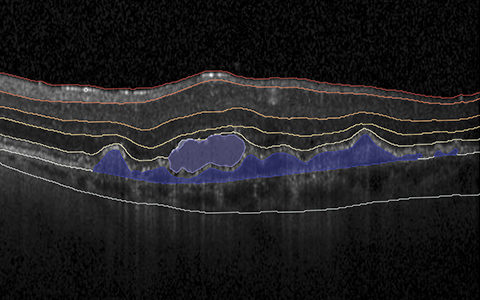 Heidelberg Engineering SPECTRALIS OCT Bild verarbeitet mit RetinAIs zertifizierten KI-Modellen