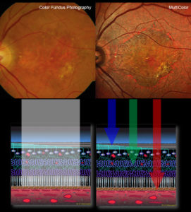 The SPECTRALIS MultiColor Module is an imaging modality which utilizes confocal scanning laser technology instead of white light to visualize the retina.