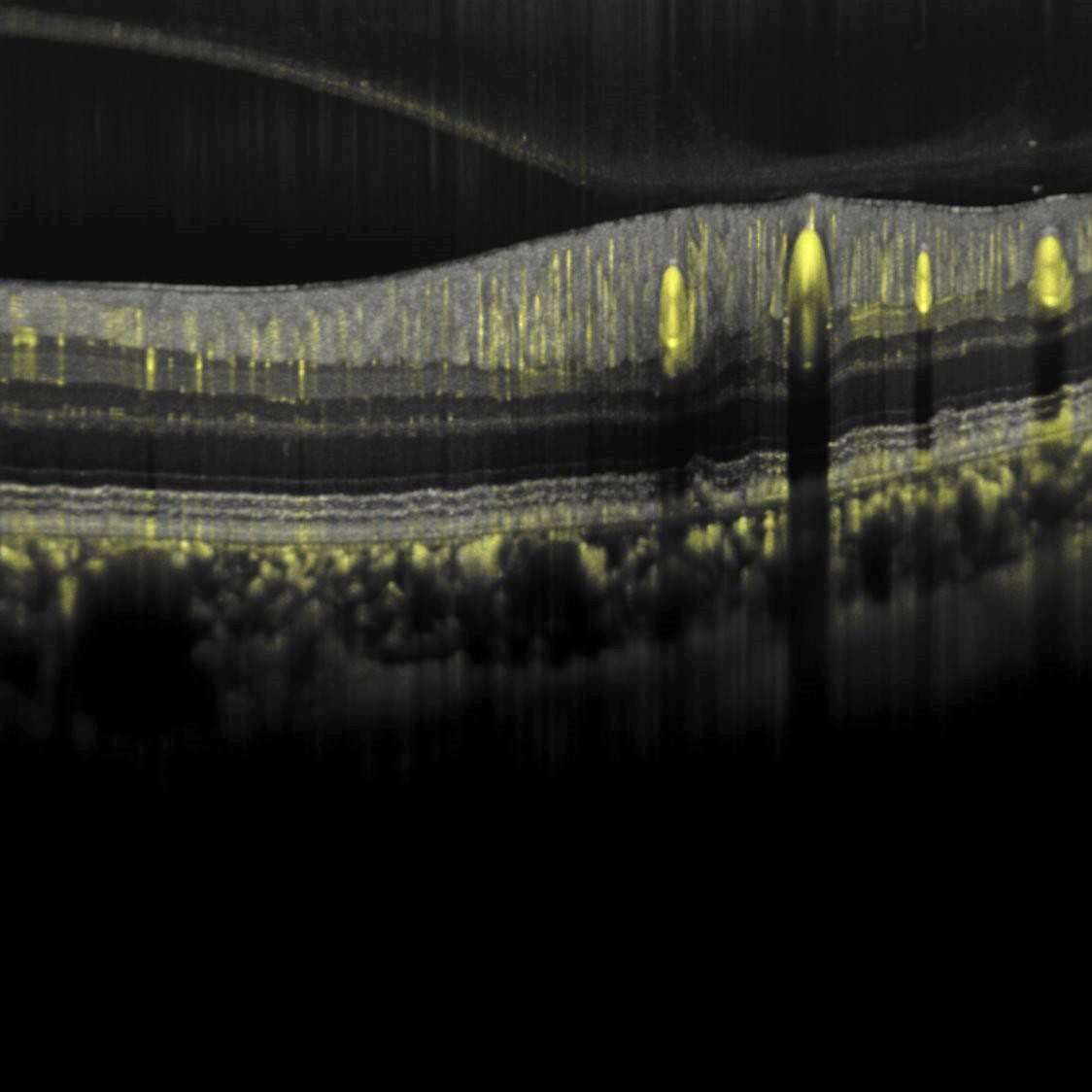 Posterior Segment & Glaucoma