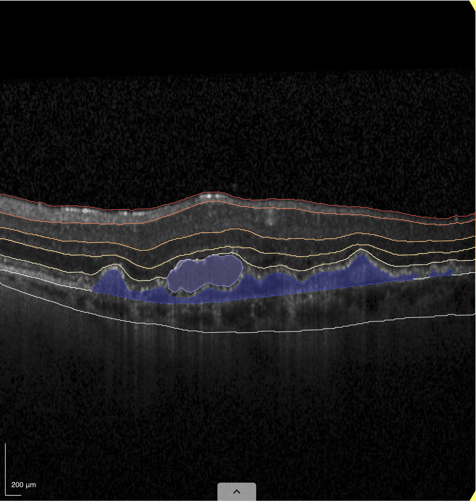 Heidelberg Engineering SPECTRALIS OCT image processed with RetinAI's certified AI models. 