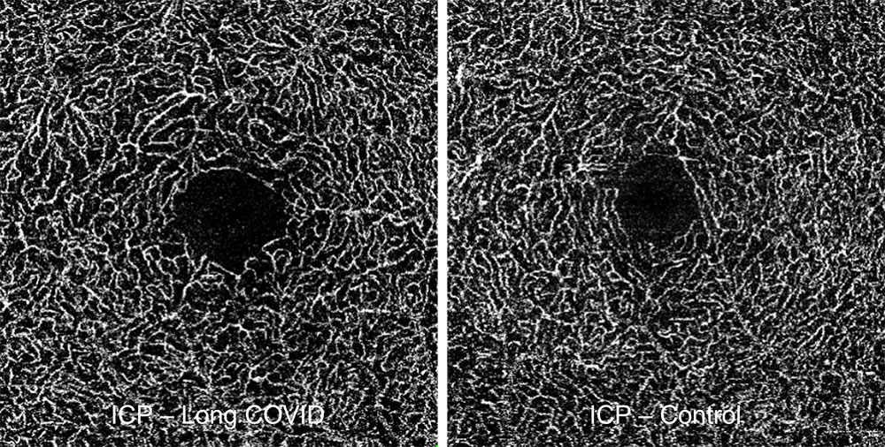 Intermediate capillary plexus (ICP) in a long COVID patient vs. a healthy subject.