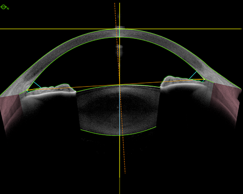 ANTERION metrics that are generated based on the location of the scleral spur