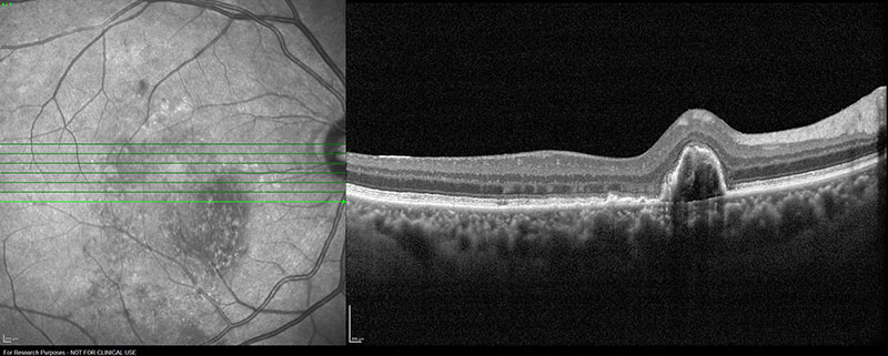 High-resolution OCT image of a polypoidal choroidal vasculopathy (PCV)