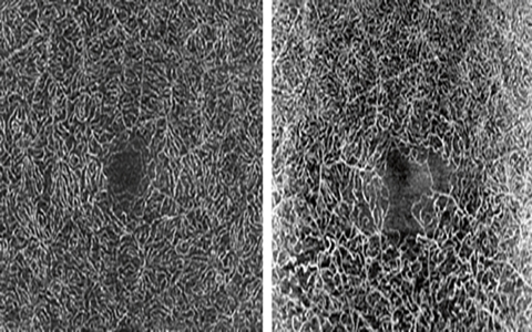 Left: OCT Angiography of the deep vascular network in a healthy eye. Right: OCT Angiography of an old BRVO with visible changes in the deep vascular network, clearly seen between inferior and superior. OCT Angiography will build on the OCT2 Module.