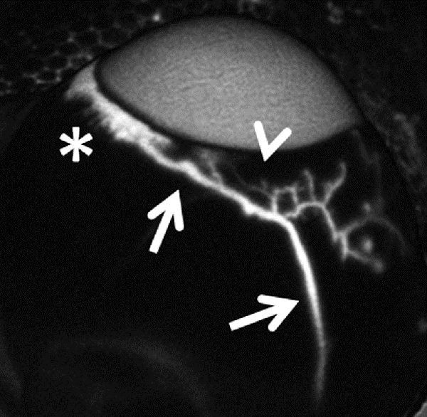 Aqueous angiography demonstrating aqueous humor outflow starting from peri-limbal structures (asterisk; trabecular meshwork, Schlemm’s Canal, and collector channels) to a distal episcleral veins (arrows). Segmental flow is seen in peri-limbal areas without outflow (arrowhead).