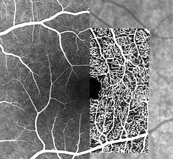 Hybrid angiography with SPECTRALIS high-resolution OCT Angiography Module identifies vascular detail and correlates it with dye-based angiography. Left to right: FA, OCTA and IR images.