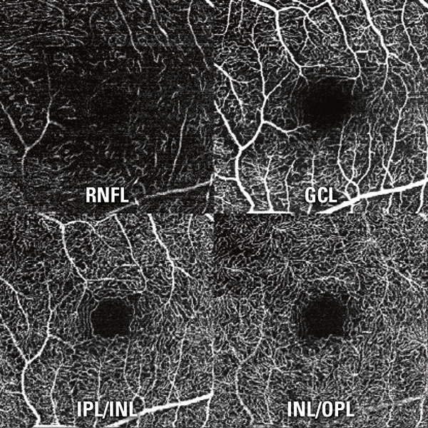 The SPECTRALIS OCT Angiography Module non-invasively produces detailed, three-dimensional representations of the perfused retinal and choroidal vasculatures.