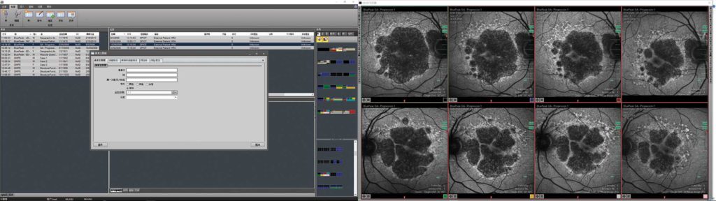 The next generation HEYEX software in a dual monitor setup: The monitor on the left shows the navigator screen with the versatile data management tools. The one on the right shows the multi-modality viewer with an automatic layout for BluePeak autofluorescense images to efficiently visualize structural changes over time. 