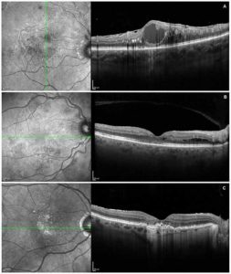 Macular oedema secondary to branch retinal vein occlusion with epiretinal membrane (image A). Diabetic retinopathy with secondary maculopathy (image B). Post-treatment wet AMD with RPE atrophy and sub-retinal fibrosis (image C).