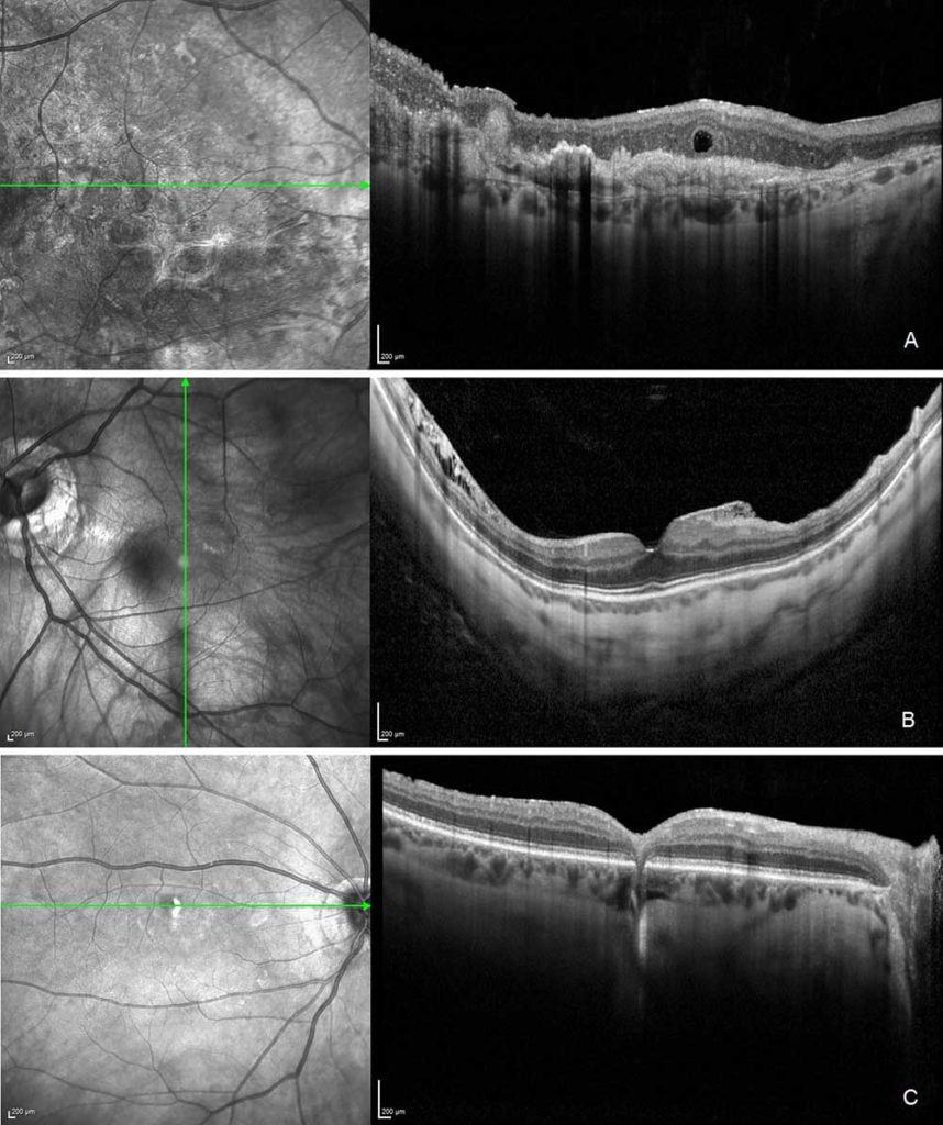 The patient volunteers exhibited wet AMD (image a), myopic macular schisis and epiretinal membrane (image b) and asymptomatic chorioretinal scar (image c).