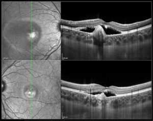 The winning image showing bilateral adult vitelliform macular dystrophy in a 19 year old patient.