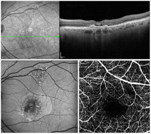 Infrared fundus image with OCT (top), autofluorescence (bottom left) and OCT Angiography (bottom right) images from OCT LIVE Masterclass patient with dry and neovascular AMD.