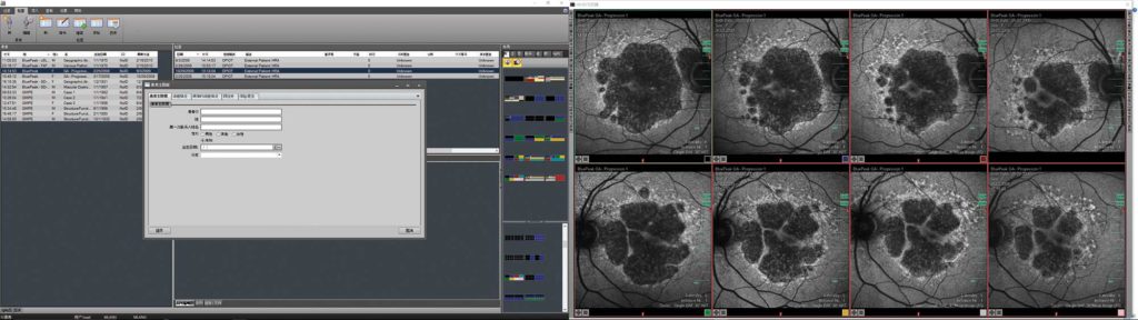 The next generation HEYEX software in a dual monitor setup: The monitor on the left shows the navigator screen with the versatile data management tools. The one on the right shows the multi-modality viewer with an automatic layout for BluePeak autofluorescense images to efficiently visualize structural changes over time.