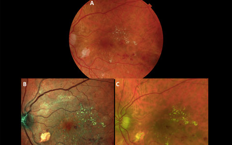 Heidelberg Engineering’s SPECTRALIS MultiColor Module Shines at ARVO in Comparisons to Color Fundus Photography