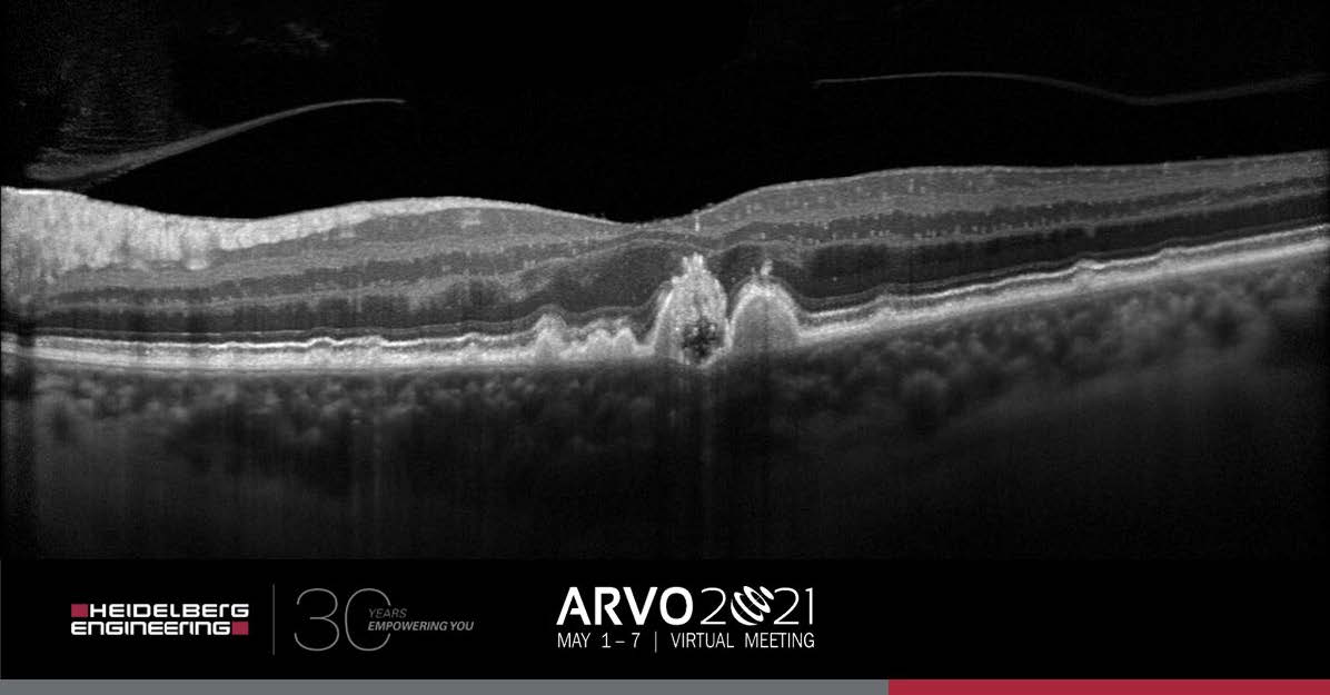 High-resolution OCT scan of a patient with soft and calcified drusen taken with a Heidelberg Engineering prototype, not available commercially.